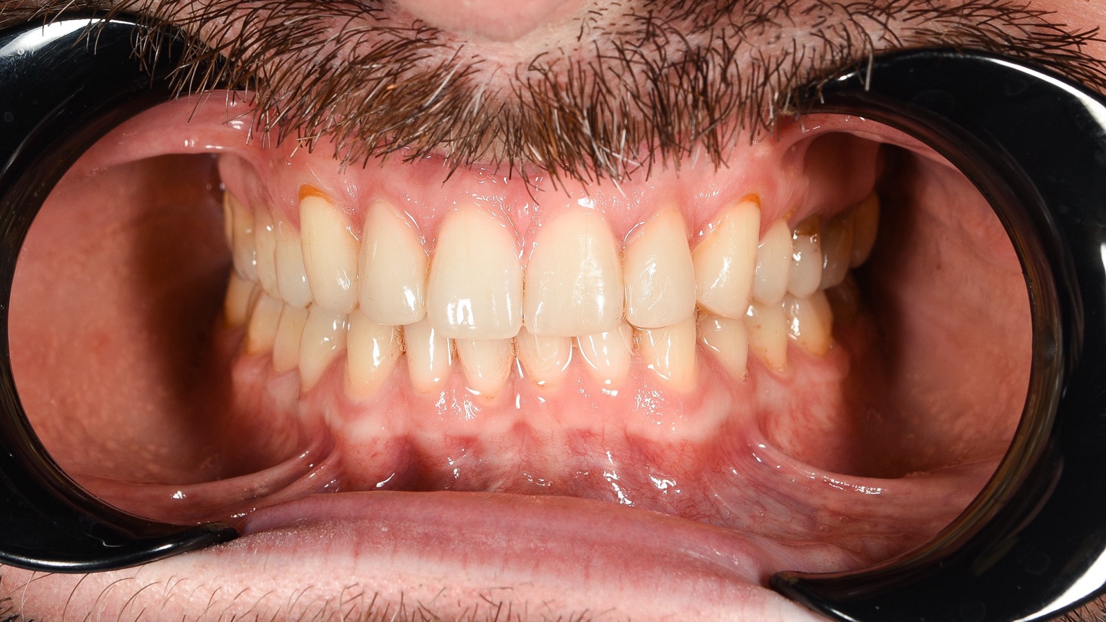 Pacjent po leczeniu Invisalign — domknięta diastema, równy łuk